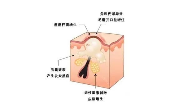 痘天使专业祛痘