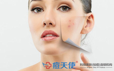 祛痘口碑最好十大排名：痘天使专业祛痘连锁机构荣登榜首