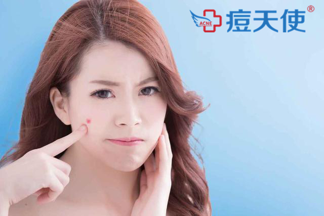 战“痘”秘籍：长痘痘了能不能用手挤？