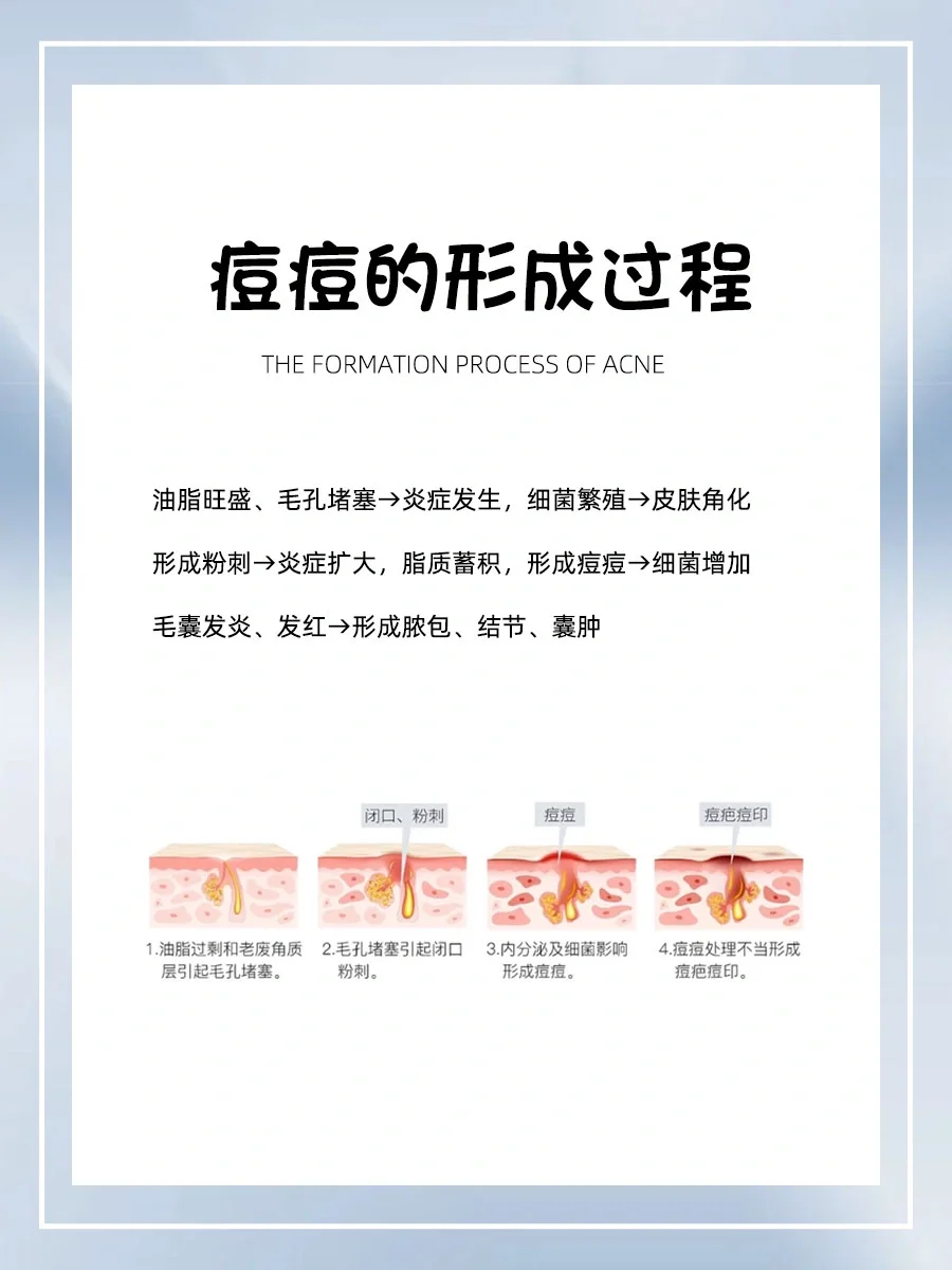 痘痘的形成过程