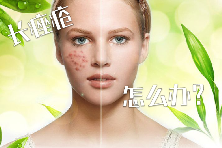 长痤疮怎么办
