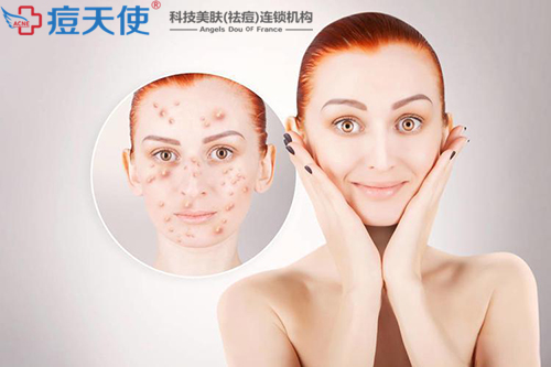 痘痘怎么快速消除？