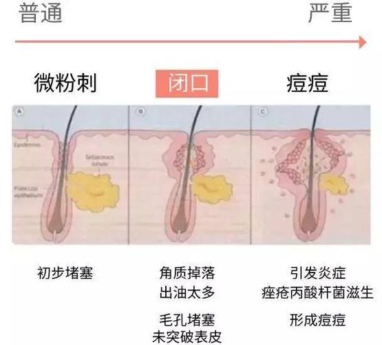 痘痘粉刺闭口有什么区别