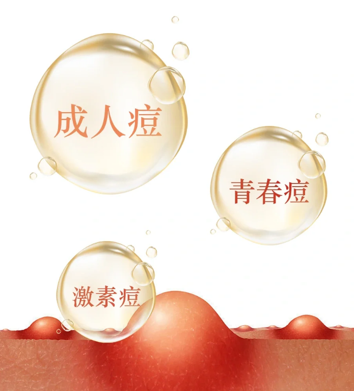 成人痘、青春痘、激素痘