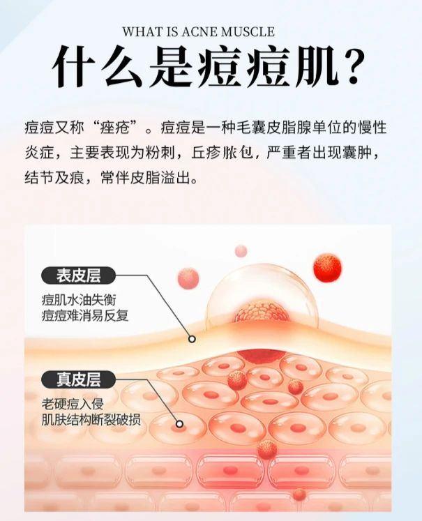 什么是痘痘肌