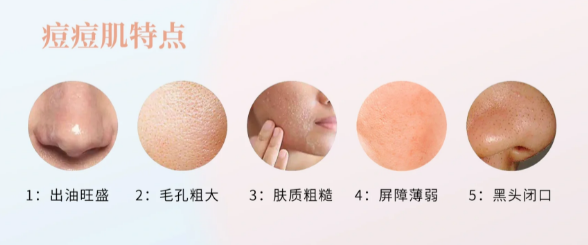 痘痘肌的特点