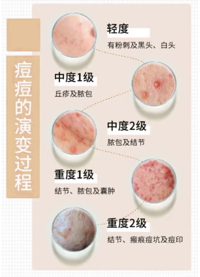 痘痘肌问题
