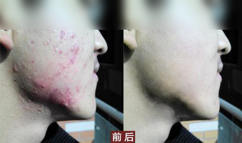 十年抗痘路漫漫，内调外养打造无痘体质