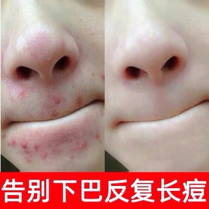 下巴长痘痘如何调理