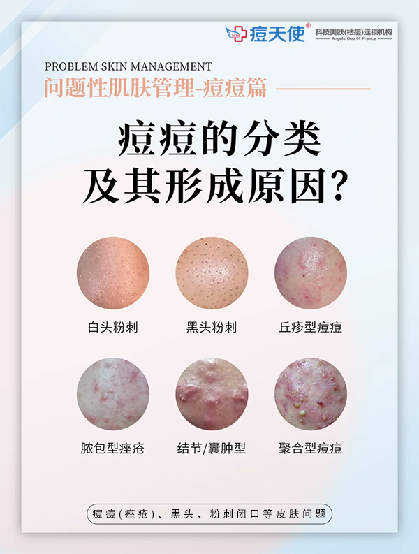 痘痘的分类及其形成的原因