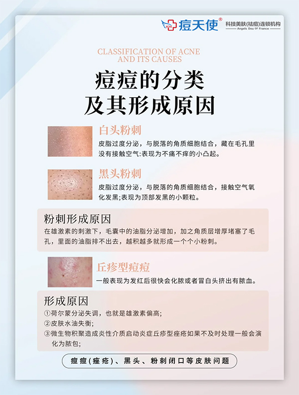 白头粉刺、黑头粉刺、丘疹型痘痘