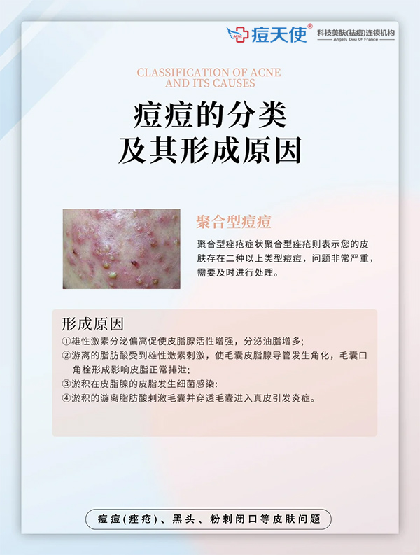 聚合型痘痘的形成原因