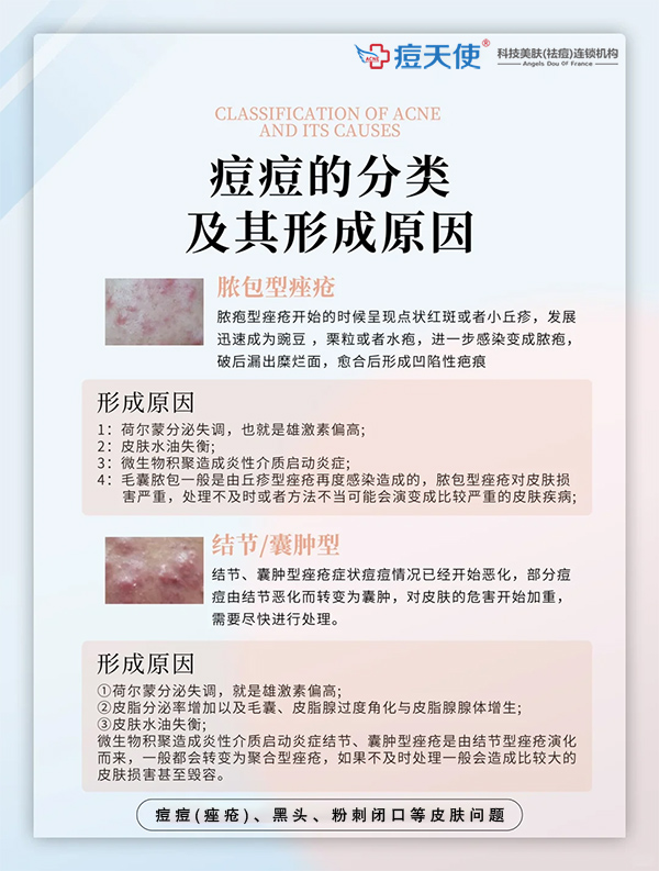 脓包型痤疮、结节(囊肿型)痘痘