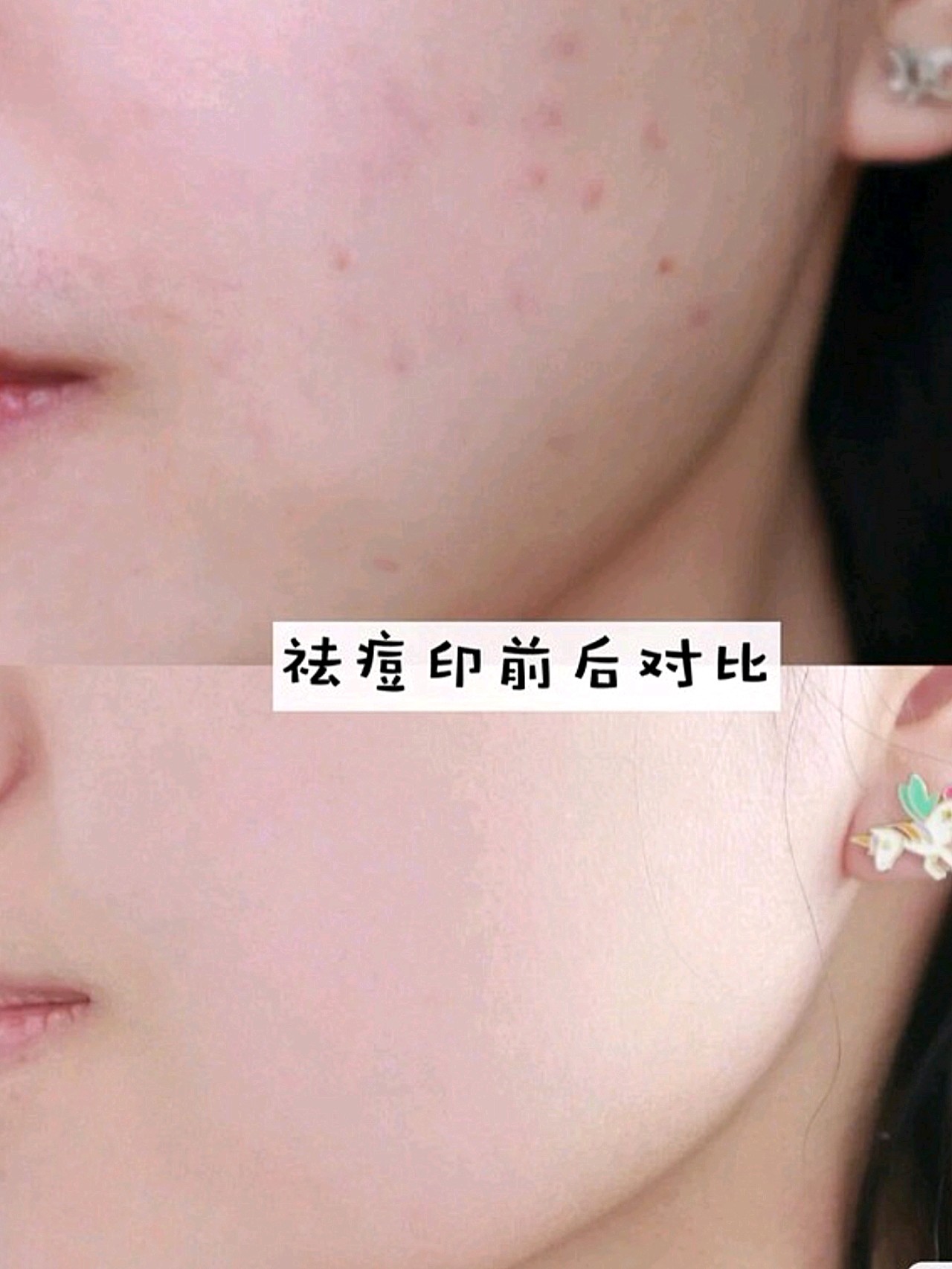 祛痘印前后对比