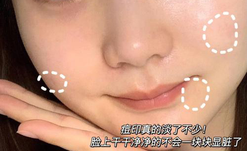 祛痘印后的照片
