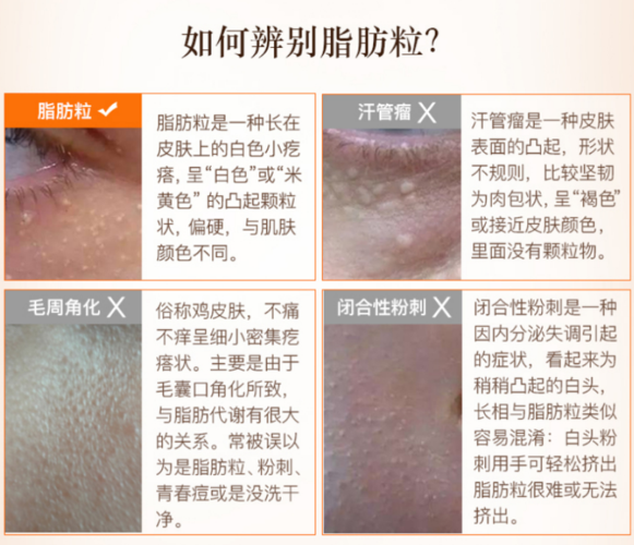 如何辨别脂肪粒