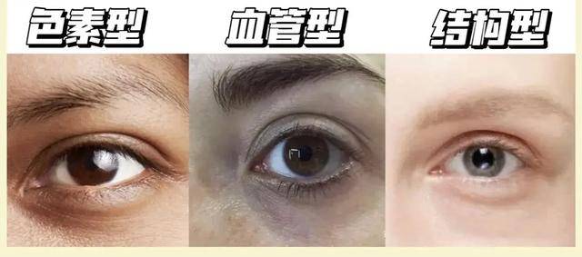 黑眼圈的类型