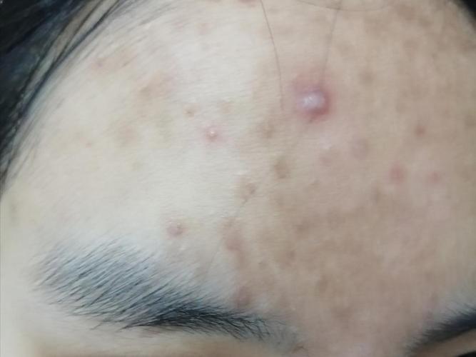 痘痘的成因