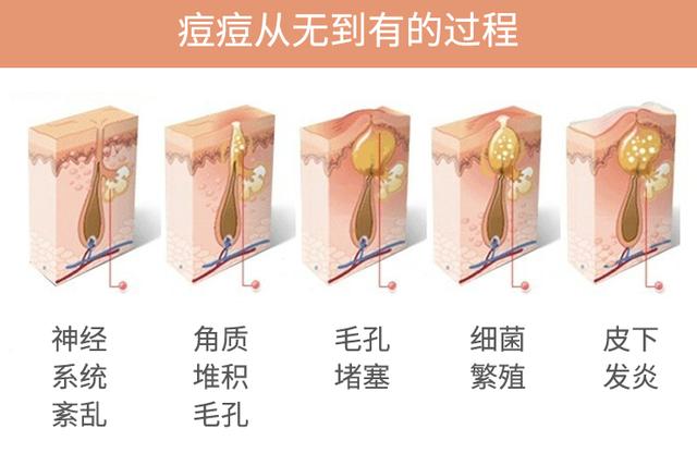 痘痘的形成机制