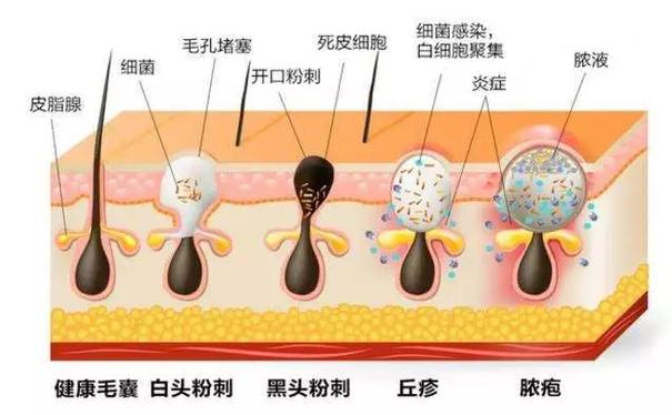解决闭口粉刺：日常护理与专业治疗的完美结合