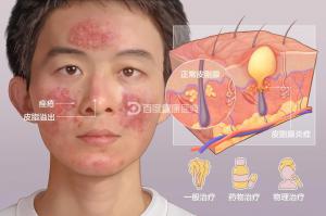 什么是痘痘？