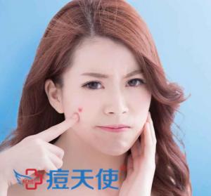 战“痘”秘籍：长痘痘了能不能用手挤？