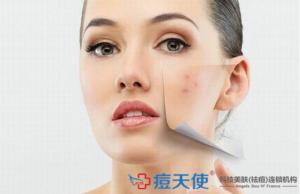 痤疮去哪里看？痘天使专业祛痘机构助您找回光滑肌肤