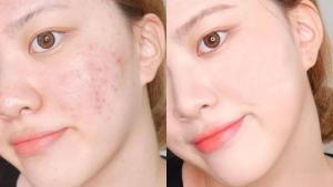 痘印消除注意事项有哪些？