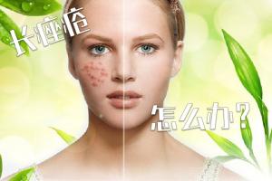 长痤疮怎么办？