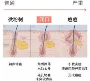 痘痘粉刺闭口什么区别