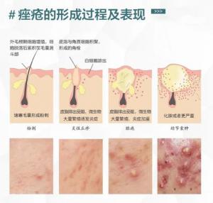 痘痘困扰你多年？这些原因可能是罪魁祸首！