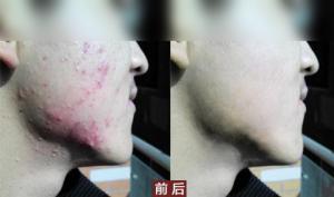 十年抗痘路漫漫，内调外养打造无痘体质：告别痤疮痘痘的秘诀大公开！
