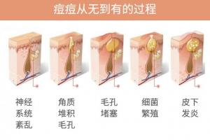 痘痘背后的科学：了解皮肤的生理机制