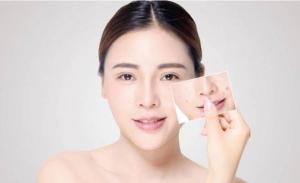 如何选择适合痘痘肌的化妆品：美丽肌肤的秘诀