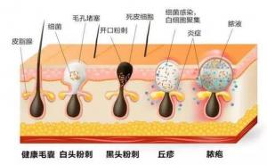 解决闭口粉刺：日常护理与专业治疗的完美结合