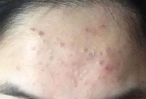 粉刺闭口的科学治疗与日常护理